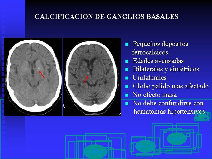 CALCIFICACION DE GANGLIOS BASALES n n n n Pequeños depósitos ferrocálcicos Edades avanzadas Bilaterales