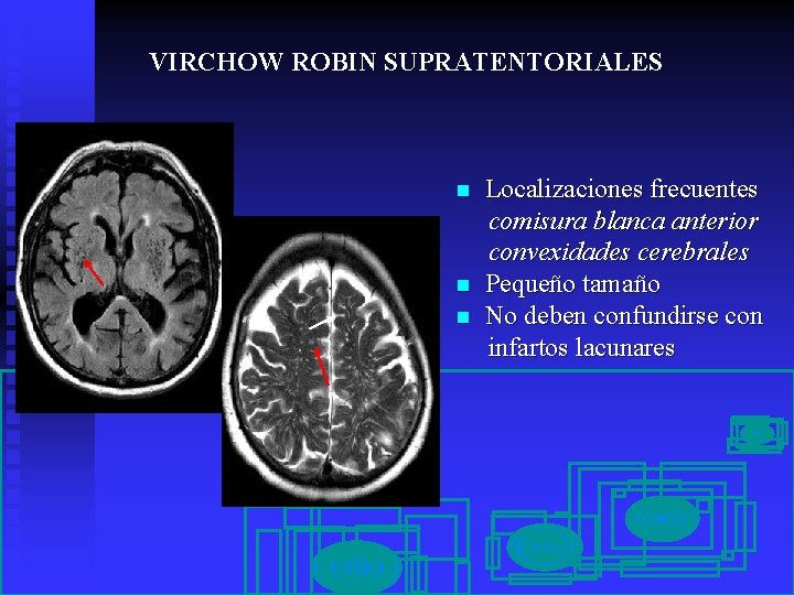 VIRCHOW ROBIN SUPRATENTORIALES n n n Localizaciones frecuentes comisura blanca anterior convexidades cerebrales Pequeño