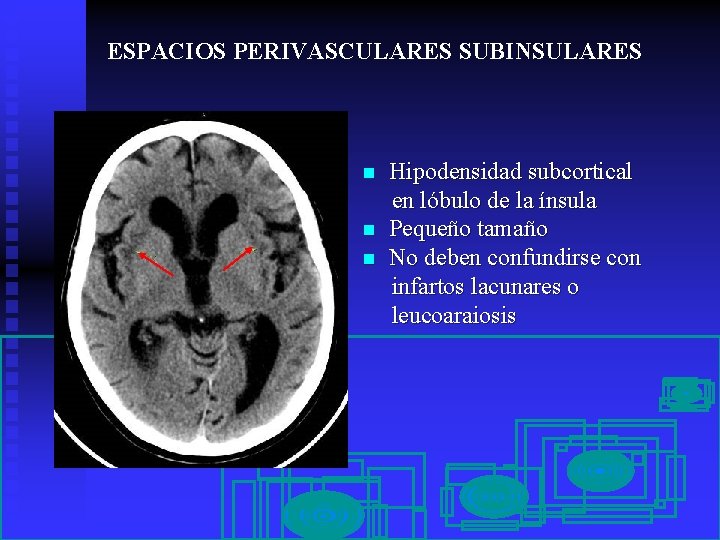 ESPACIOS PERIVASCULARES SUBINSULARES n n n Hipodensidad subcortical en lóbulo de la ínsula Pequeño