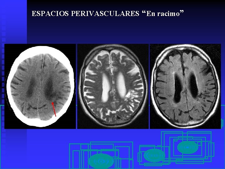 ESPACIOS PERIVASCULARES “En racimo” 