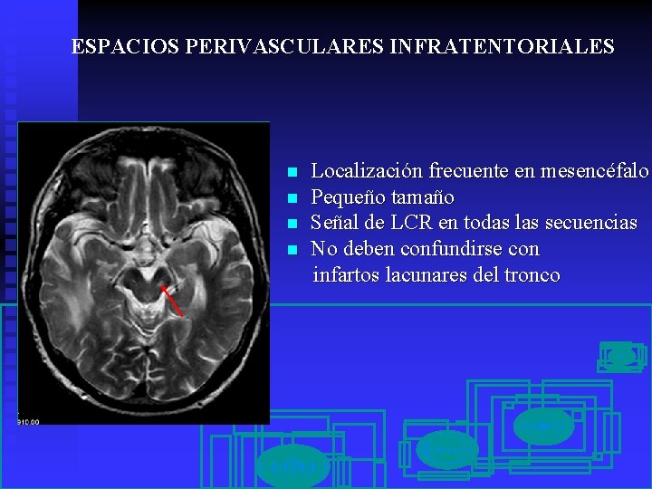 ESPACIOS PERIVASCULARES INFRATENTORIALES n n Localización frecuente en mesencéfalo Pequeño tamaño Señal de LCR