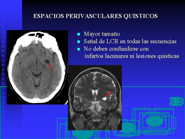 ESPACIOS PERIVASCULARES QUISTICOS n n n Mayor tamaño Señal de LCR en todas las