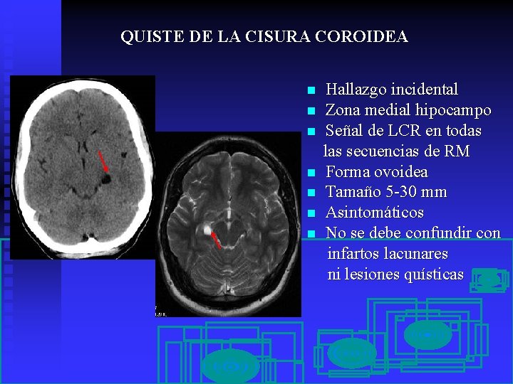 QUISTE DE LA CISURA COROIDEA n n n n Hallazgo incidental Zona medial hipocampo