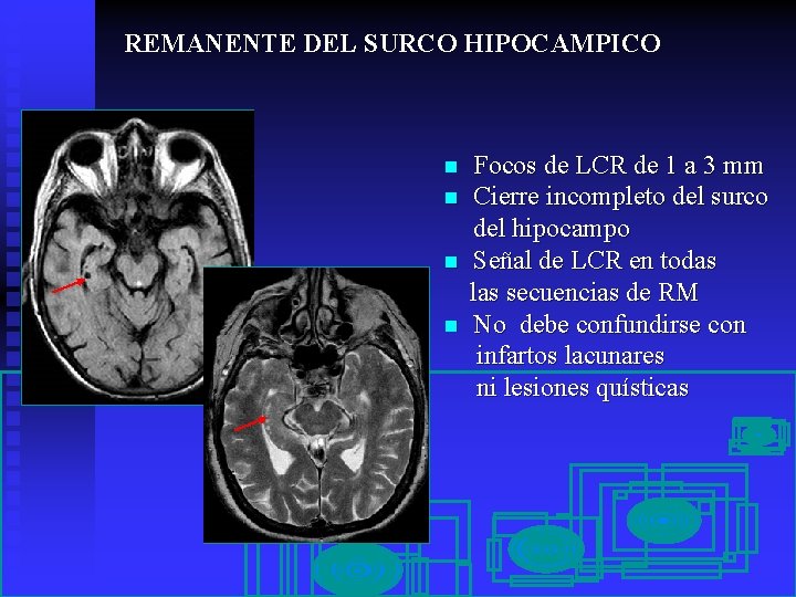 REMANENTE DEL SURCO HIPOCAMPICO n n Focos de LCR de 1 a 3 mm