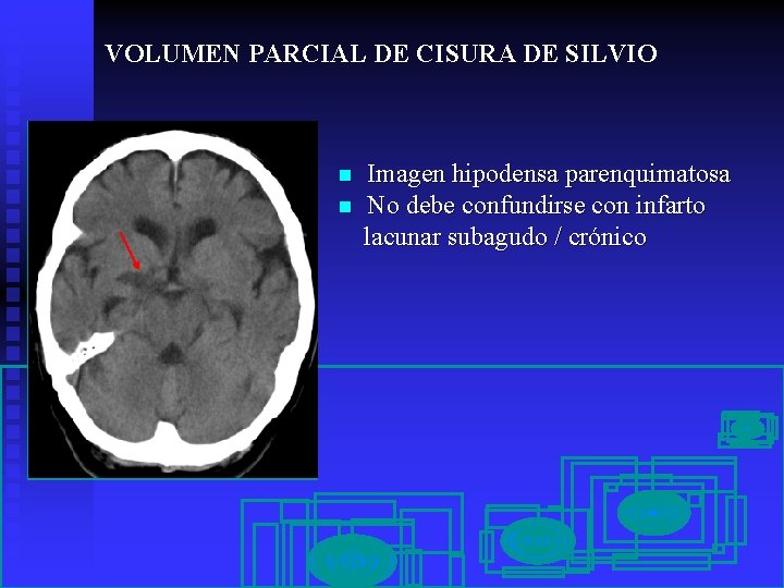 VOLUMEN PARCIAL DE CISURA DE SILVIO n n Imagen hipodensa parenquimatosa No debe confundirse