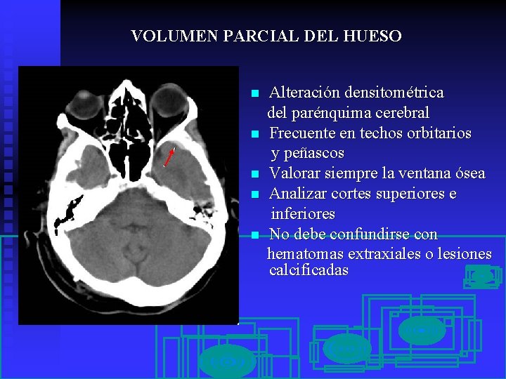 VOLUMEN PARCIAL DEL HUESO n n n Alteración densitométrica del parénquima cerebral Frecuente en