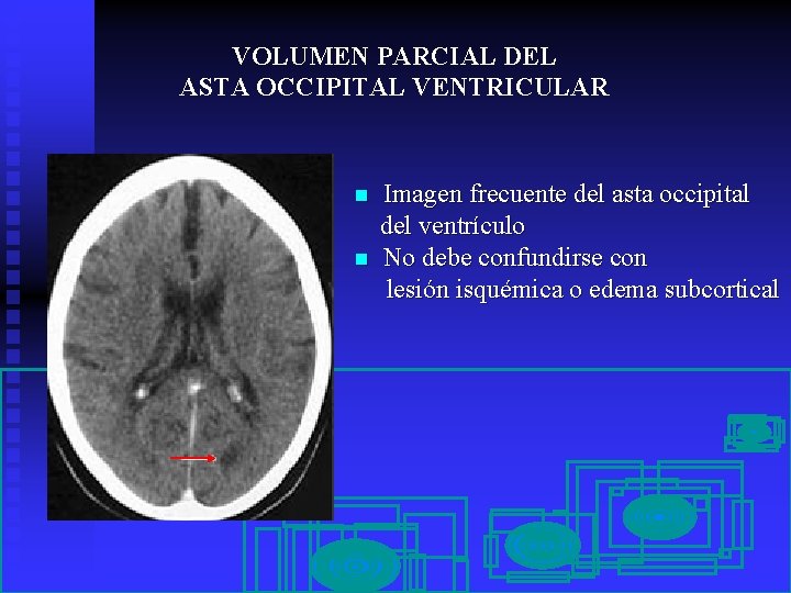 VOLUMEN PARCIAL DEL ASTA OCCIPITAL VENTRICULAR n n Imagen frecuente del asta occipital del