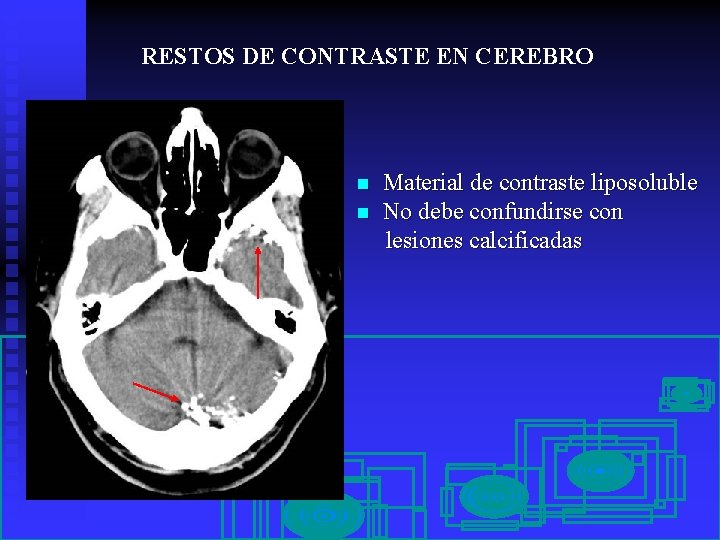 RESTOS DE CONTRASTE EN CEREBRO n n Material de contraste liposoluble No debe confundirse