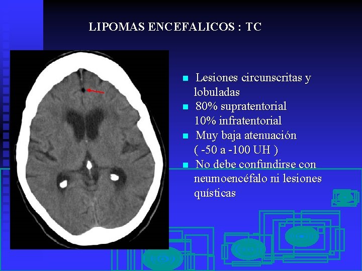 LIPOMAS ENCEFALICOS : TC n n Lesiones circunscritas y lobuladas 80% supratentorial 10% infratentorial