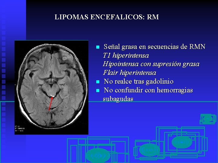 LIPOMAS ENCEFALICOS: RM n n n Señal grasa en secuencias de RMN T 1