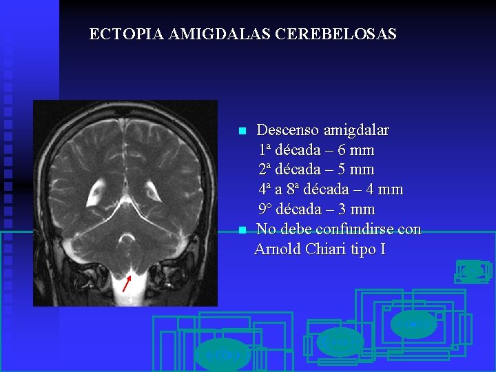 ECTOPIA AMIGDALAS CEREBELOSAS n n Descenso amigdalar 1ª década – 6 mm 2ª década