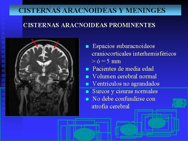 CISTERNAS ARACNOIDEAS Y MENINGES CISTERNAS ARACNOIDEAS PROMINENTES n n n Espacios subaracnoideos craniocorticales interhemisféricos