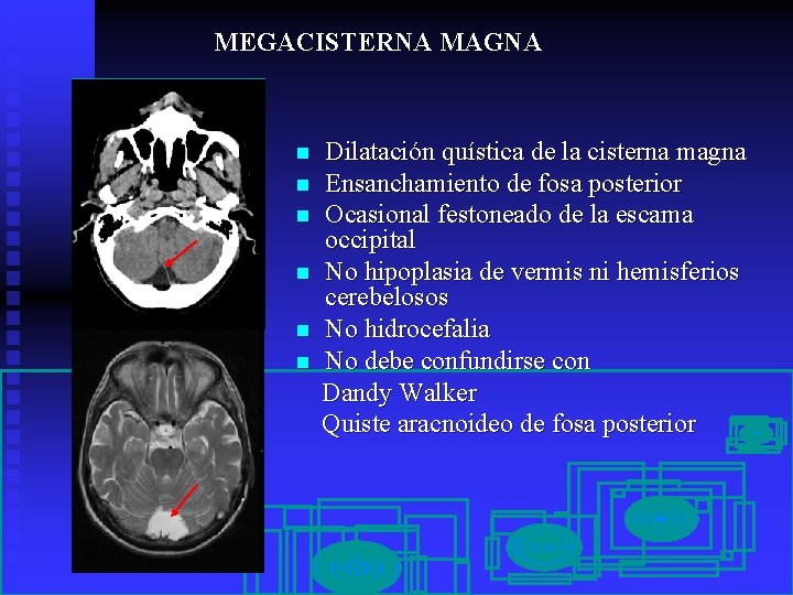 MEGACISTERNA MAGNA n n n Dilatación quística de la cisterna magna Ensanchamiento de fosa