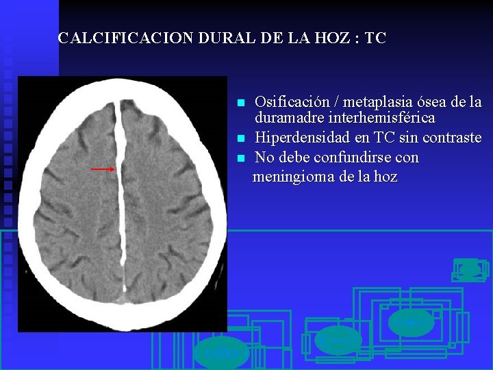 CALCIFICACION DURAL DE LA HOZ : TC n n n Osificación / metaplasia ósea