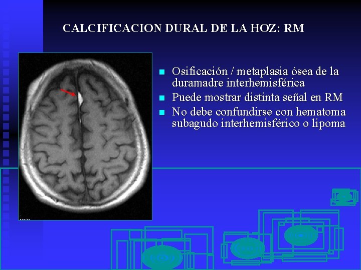 CALCIFICACION DURAL DE LA HOZ: RM n n n Osificación / metaplasia ósea de