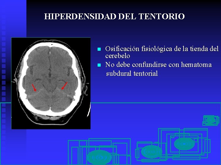 HIPERDENSIDAD DEL TENTORIO n n Osificación fisiológica de la tienda del cerebelo No debe