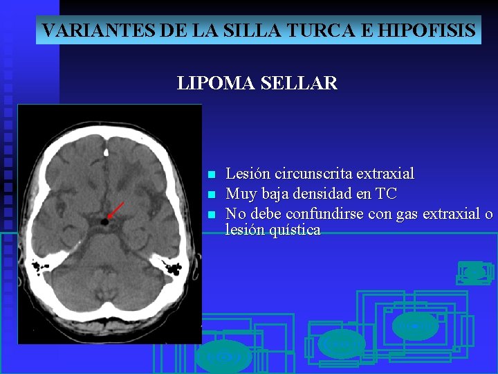 VARIANTES DE LA SILLA TURCA E HIPOFISIS LIPOMA SELLAR n n n Lesión circunscrita