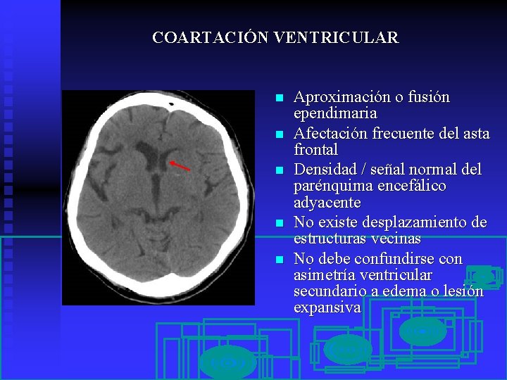 COARTACIÓN VENTRICULAR n n n Aproximación o fusión ependimaria Afectación frecuente del asta frontal