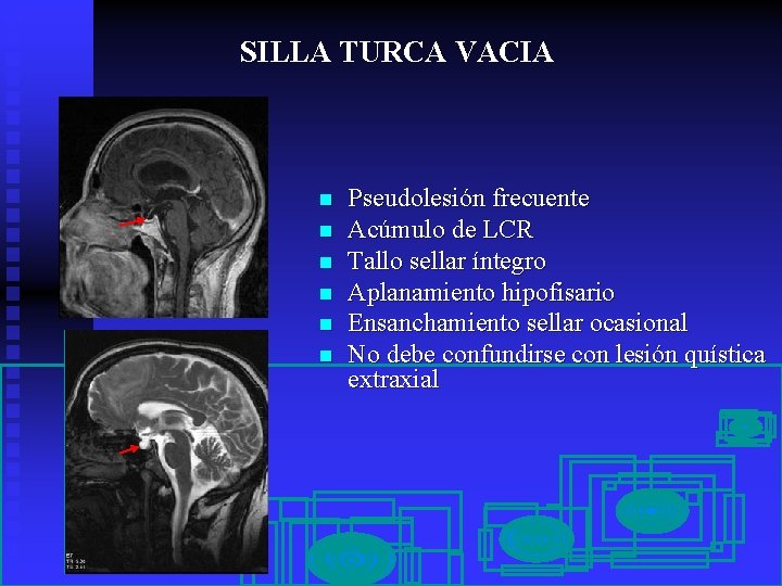 SILLA TURCA VACIA n n n Pseudolesión frecuente Acúmulo de LCR Tallo sellar íntegro