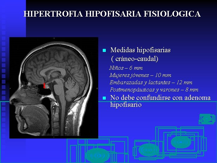 HIPERTROFIA HIPOFISARIA FISIOLOGICA n Medidas hipofisarias ( cráneo-caudal) Niños – 6 mm Mujeres jóvenes