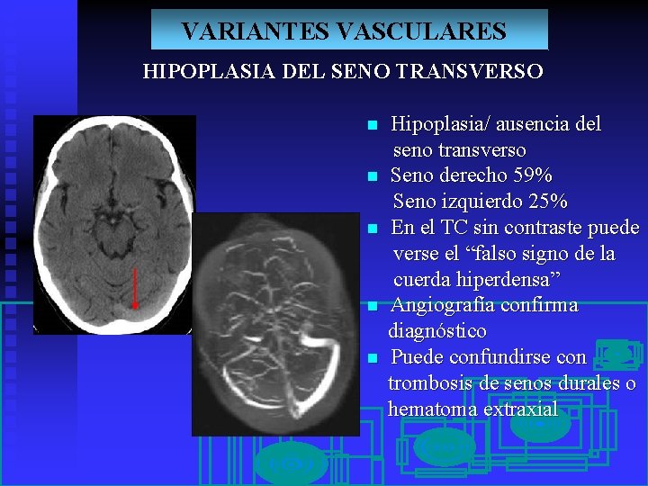 VARIANTES VASCULARES HIPOPLASIA DEL SENO TRANSVERSO n n n Hipoplasia/ ausencia del seno transverso