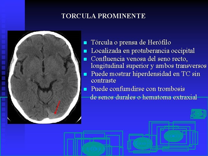 TORCULA PROMINENTE n n n Tórcula o prensa de Herófilo Localizada en protuberancia occipital