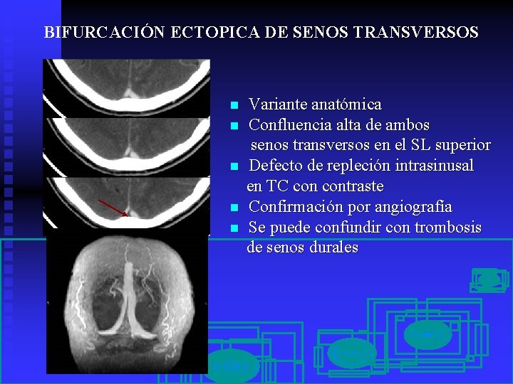 BIFURCACIÓN ECTOPICA DE SENOS TRANSVERSOS n n n Variante anatómica Confluencia alta de ambos