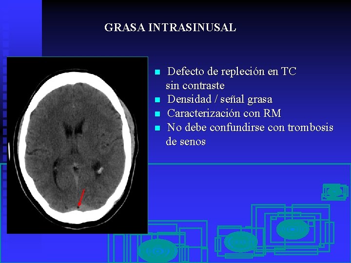 GRASA INTRASINUSAL n n Defecto de repleción en TC sin contraste Densidad / señal
