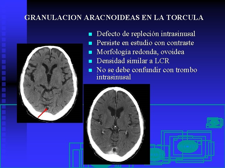 GRANULACION ARACNOIDEAS EN LA TORCULA n n n Defecto de repleción intrasinusal Persiste en