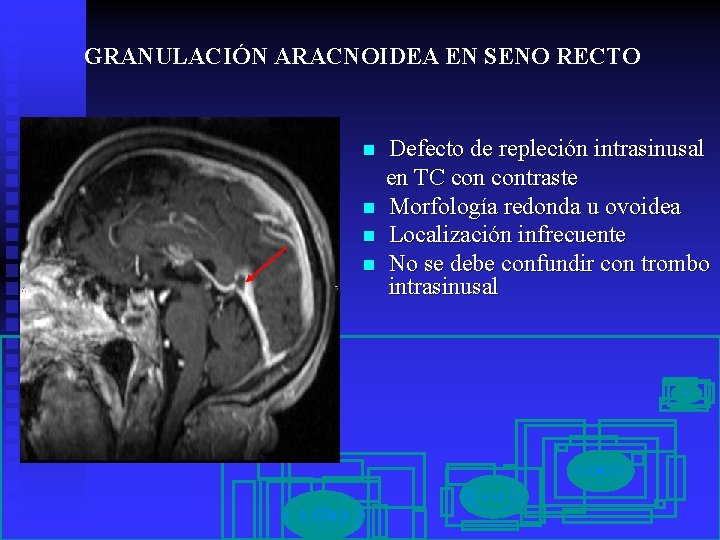 GRANULACIÓN ARACNOIDEA EN SENO RECTO n n Defecto de repleción intrasinusal en TC contraste
