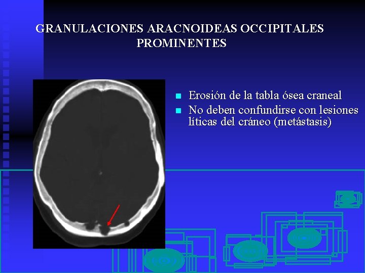 GRANULACIONES ARACNOIDEAS OCCIPITALES PROMINENTES n n Erosión de la tabla ósea craneal No deben