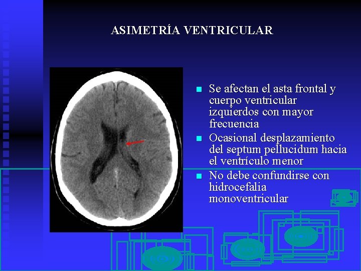 ASIMETRÍA VENTRICULAR n n n Se afectan el asta frontal y cuerpo ventricular izquierdos