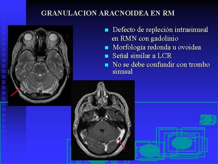 GRANULACION ARACNOIDEA EN RM n n Defecto de repleción intrasinusal en RMN con gadolinio