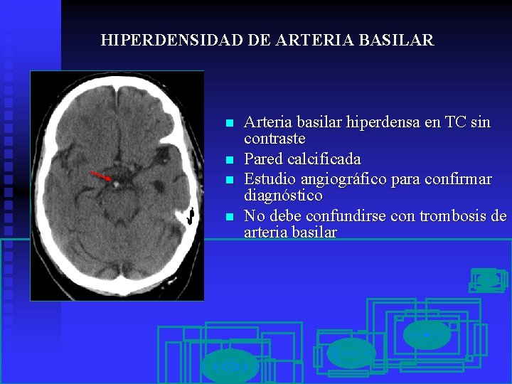 HIPERDENSIDAD DE ARTERIA BASILAR n n Arteria basilar hiperdensa en TC sin contraste Pared