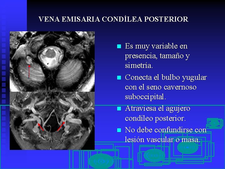 VENA EMISARIA CONDÍLEA POSTERIOR n n Es muy variable en presencia, tamaño y simetría.