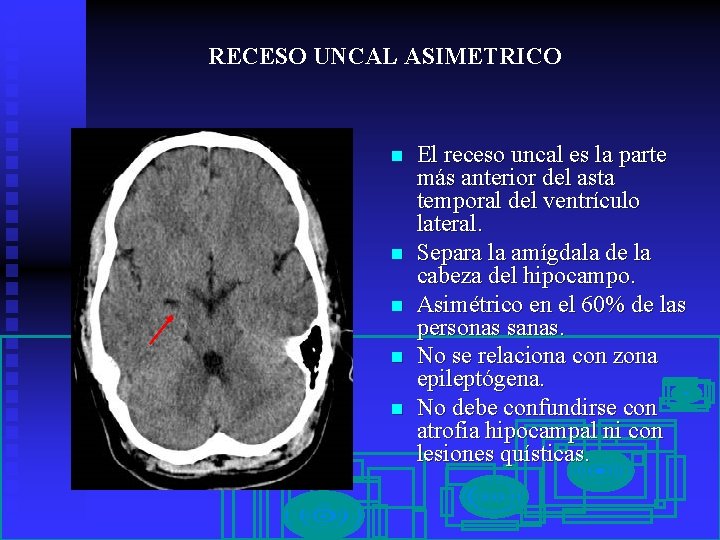RECESO UNCAL ASIMETRICO n n n El receso uncal es la parte más anterior
