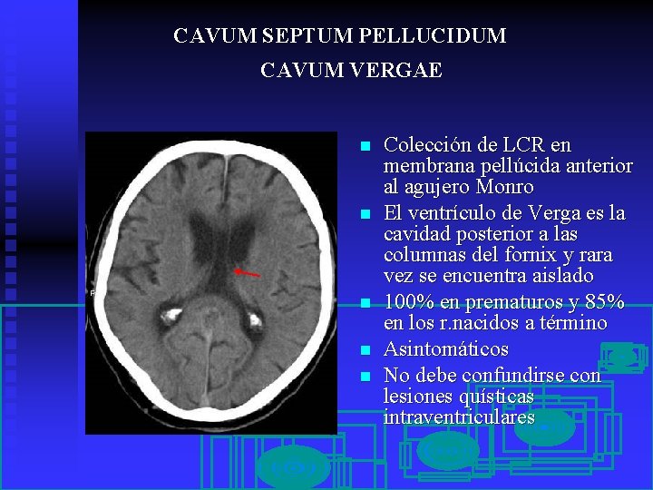 CAVUM SEPTUM PELLUCIDUM CAVUM VERGAE n n n Colección de LCR en membrana pellúcida
