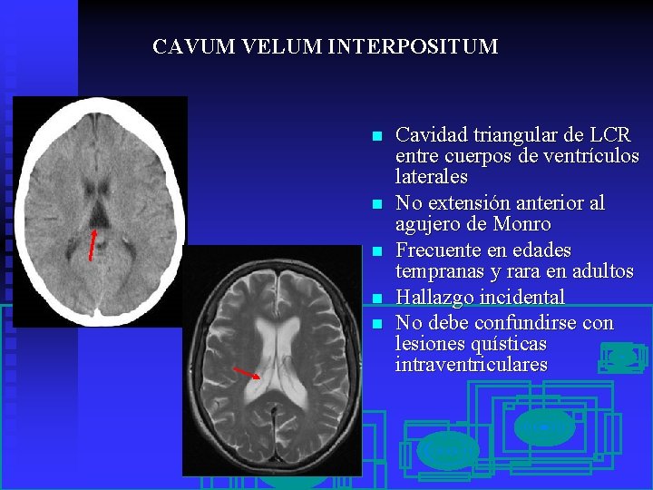 CAVUM VELUM INTERPOSITUM n n n Cavidad triangular de LCR entre cuerpos de ventrículos