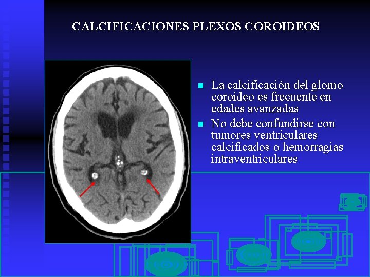CALCIFICACIONES PLEXOS COROIDEOS n n La calcificación del glomo coroideo es frecuente en edades