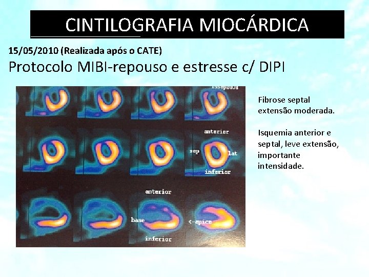 CINTILOGRAFIA MIOCÁRDICA 15/05/2010 (Realizada após o CATE) Protocolo MIBI-repouso e estresse c/ DIPI Fibrose CINTILOGRAFIA MIOCÁRDICA 15/05/2010 (Realizada após o CATE) Protocolo MIBI-repouso e estresse c/ DIPI Fibrose