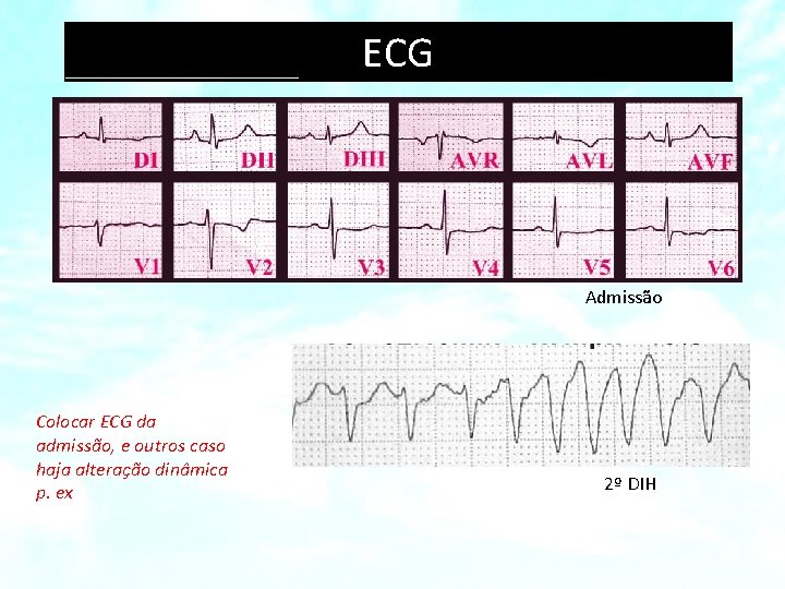 ECG Admissão Colocar ECG da admissão, e outros caso haja alteração dinâmica p. ex