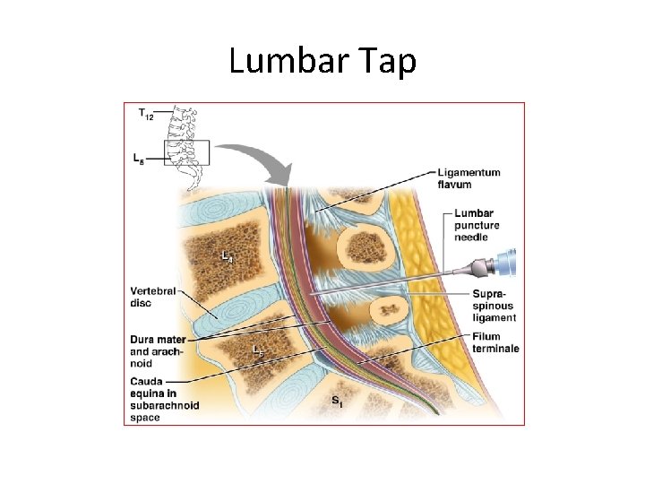 Lumbar Tap 