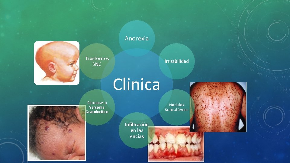 Anorexia Trastornos SNC Irritabilidad Clinica Cloromas o Sarcoma Granulocitico Nódulos Subcutáneos Infiltración en las