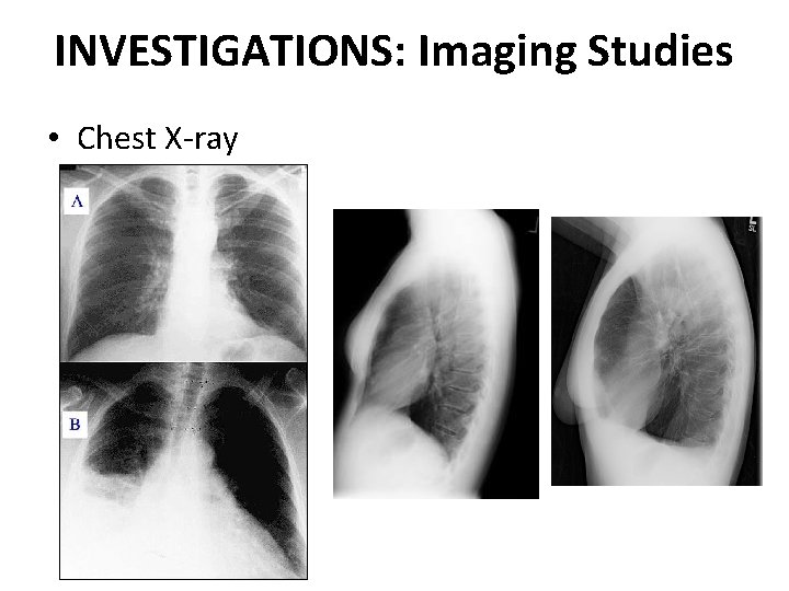 INVESTIGATIONS: Imaging Studies • Chest X-ray 