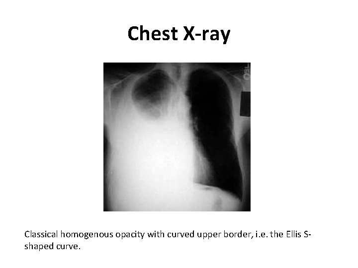 Chest X-ray Classical homogenous opacity with curved upper border, i. e. the Ellis Sshaped