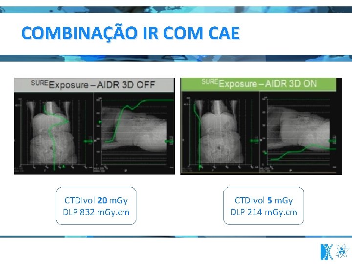 COMBINAÇÃO IR COM CAE CTDIvol 20 m. Gy DLP 832 m. Gy. cm CTDIvol