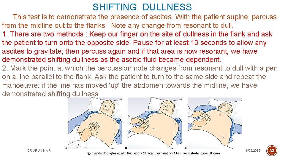 SHIFTING DULLNESS This test is to demonstrate the presence of ascites. With the patient