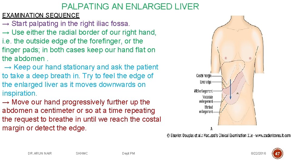PALPATING AN ENLARGED LIVER EXAMINATION SEQUENCE → Start palpating in the right iliac fossa.