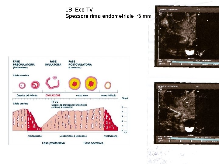 LB: Eco TV Spessore rima endometriale ~3 mm 