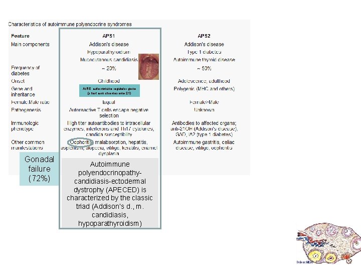 AIRE: autoimmune regulator gene (short arm chromosome 21) Gonadal failure (72%) Autoimmune polyendocrinopathycandidiasis-ectodermal dystrophy